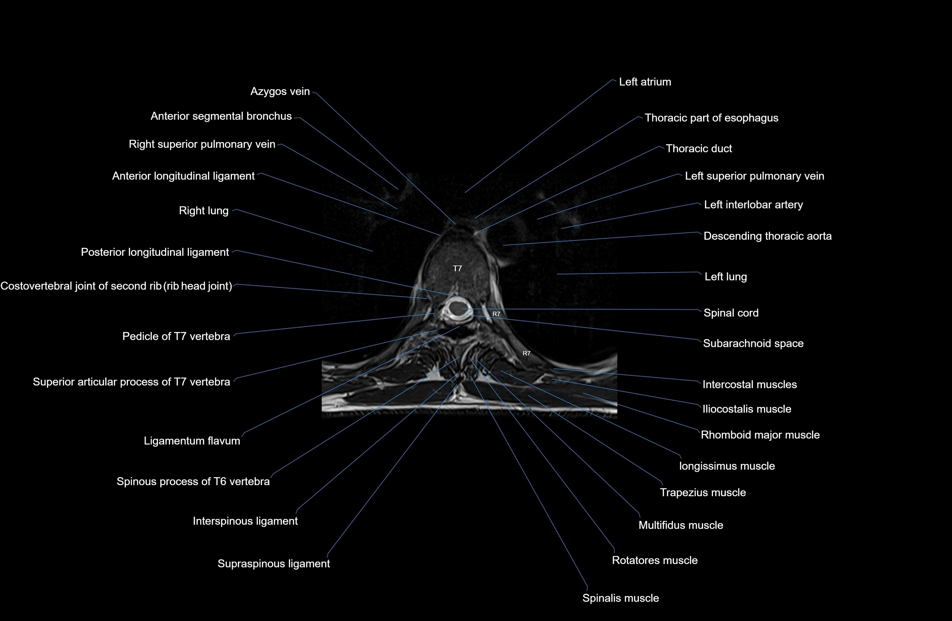 MRI thoracic spine axial  cross sectional anatomy 3T radiology  image-img-00001-00045.webp